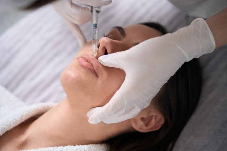Nasolabial Fold Fillers